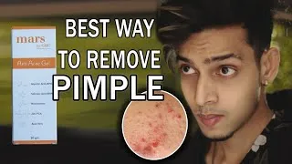Thumbnail: Best Way To Remove Pimple And Acne