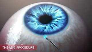 Thumbnail: Ophthalmology glaucoma IOP drainage animation