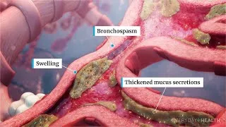 Thumbnail: What Is Severe Asthma?
