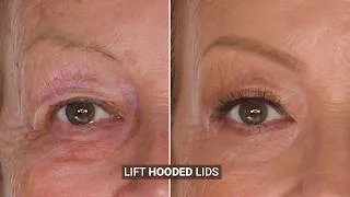 Thumbnail: How To Lift Hooded Eyes On Mature Skin