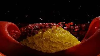 Thumbnail: Why High Cholesterol Is Dangerous