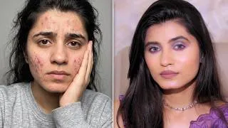 Thumbnail: Makeup for acne: I'm showing my real skin first