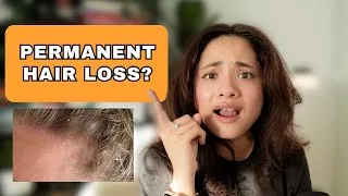 Thumbnail: Can Seborrheic Dermatitis Cause Permanent Hair Loss?
