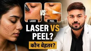 Thumbnail: Laser vs Chemical Peel: Acne, Pigmentation & Acne Scars के लिए कौन सा बेहतर है?