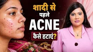 Thumbnail: Bridal Acne Treatment | शादी से पहले Pimples और Acne Marks कैसे Control करें?