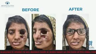 Thumbnail: Cranio-Maxillofacial Rehabilitation After Mucormycosis (Black Fungus) | Smile Gallery