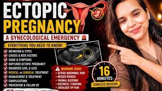 Thumbnail: 🚨 ECTOPIC PREGNANCY Full Concept Video | MBBS Exam Oriented | Handwritten Notes 📑