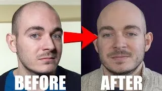 Thumbnail: 4 Years of ADHD Prescriptions | “What Is Truly Worth It?”