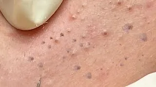 Thumbnail: Dense Blackheads Extraction | Deep Pore Cleaning – Spa Linh Mun #57