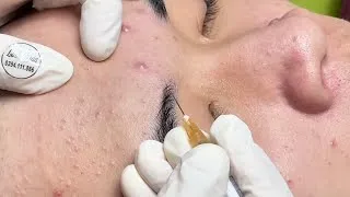 Thumbnail: Large Hidden Acne and Closed Comedones Extraction | Deep Keratin Plug Removal – Spa Linh Mun #56