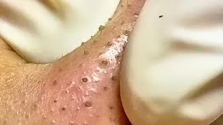 Thumbnail: Large Blackheads and Deep Pore Extraction | Thick Sebum & Keratin Plug Removal – Spa Linh Mun #55