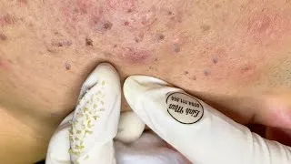 Thumbnail: Dense Blackheads and Large Hidden Acne Extraction | Thick Keratin Plug Removal – Spa Linh Mun #54