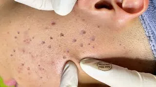 Thumbnail: Deep Blackheads and Hidden Acne Extraction | Stubborn Keratin Plug Removal – Spa Linh Mun #53