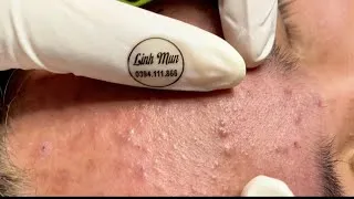 Thumbnail: Dense Hidden Acne and Closed Comedones Extraction | Deep Keratin Plug Removal – Spa Linh Mun #52