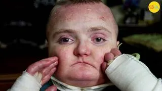 Thumbnail: The Boy With Butterfly Skin and Profound Autism