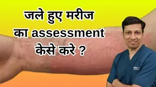 Thumbnail: How to assess severity of burn injury ? जले मरीज का assessment कैसे करे ?