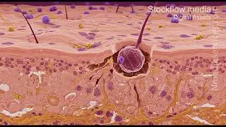 Thumbnail: Melanoma | Cancer Cell | Microscopic - 4K Stock Footage