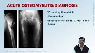 Thumbnail: Acute Osteomyelitis - A Lecture by Prof Dr Sudhir K.A.M. Shandilya
