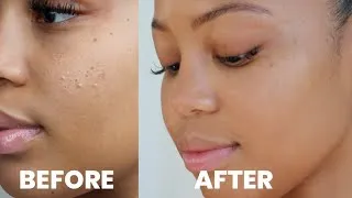 Thumbnail: How I Got Rid of My Textured Skin + Improved My Skin