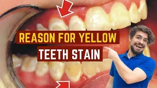 Thumbnail: Why Do Teeth Turn Yellow? | How to Whiten Them