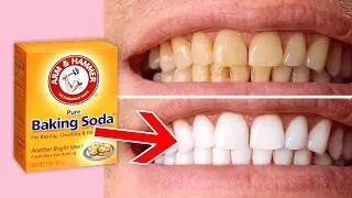Thumbnail: The Secret to No Cavities (The Truth)