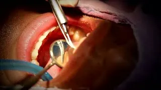 Thumbnail: When Does a Cavity Need a Filling?