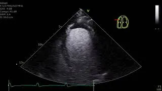 Thumbnail: Laminated LV thrombus