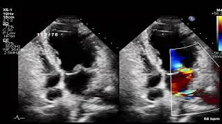 Thumbnail: Cleft Anterior Mitral Leaflet