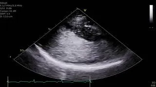 Thumbnail: HCM septal thickness with and without contrast
