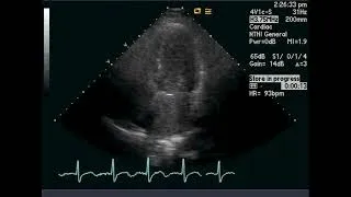Thumbnail: TTE - Extra Cardiac Shunt with Early Bubbles