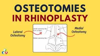 Thumbnail: Osteotomies in Rhinoplasty | Lateral Osteotomy, Medial Osteotomy, Transverse Osteotomy