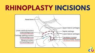 Thumbnail: Rhinoplasty Incisions |Transcolumellar incision, Rim incision, Intercartilaginous,Intracartilaginous
