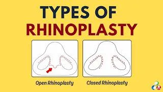 Thumbnail: Types of Rhinoplasty | Closed vs Open Rhinoplasty | Augmentation vs Reduction Rhinoplasty