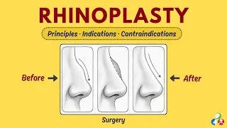 Thumbnail: Rhinoplasty - Definition, Indications, Contraindications, Principles
