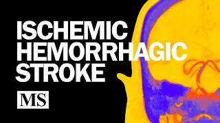Thumbnail: Introduction to Ischemic and Hemorrhagic Stroke (2025)