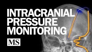 Thumbnail: External Ventricular Drainage and Intracranial Pressure Monitoring