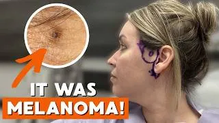 Thumbnail: How I was Diagnosed with MELANOMA! "I Knew Something was WRONG!"
