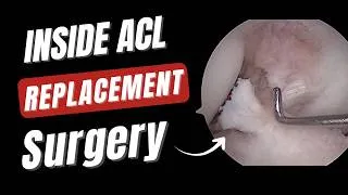 Thumbnail: Inside an ACL Surgery: Surgeon’s POV + First Rehab Session