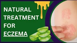 Thumbnail: Naturel Treatment for Eczema: Earth's Healing Touch 🌿