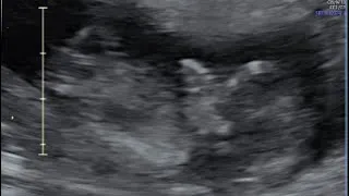 Thumbnail: COME WITH ME to my SECOND PRENATAL APPOINTMENT! ULTRASOUND & HEARTBEAT! 