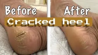 Thumbnail: How to treat cracked Heels? #howto #treat  #cracked #heels