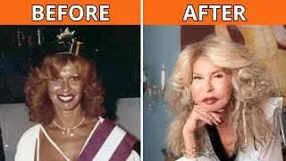 Thumbnail: 75 Celebrities Before and After Plastic Surgery