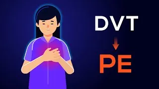 Thumbnail: Overview of Acute Pulmonary Embolism in adults: (From DVT to PE)
