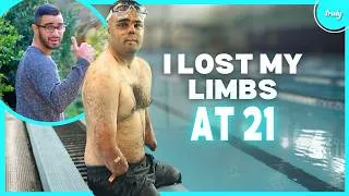 Thumbnail: I Lost My Limbs & Nose - But Not My Love For Life | BORN DIFFERENT