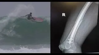 Thumbnail: HOW I BROKE MY FEMUR SUP SURFING