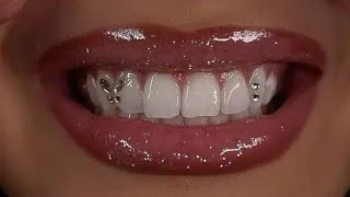 Thumbnail: Pearl white teeth + attractive smile in 1 minute 💉✨