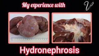 Thumbnail: Hydronephrosis #Hydronephrosis #kidney #cattle #veterinary #medicine