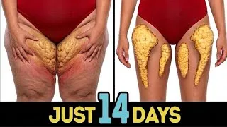 Thumbnail: Inner Thigh And Thigh Fat Exercise at Home 🔥