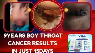Thumbnail: 9 సంవత్సరాల బాలుడికి గొంతు క్యాన్సర్‌పై అద్భుత ఫలితాలు? | VR4 Capsules అనుభవం