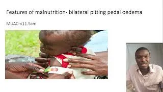 Thumbnail: Severe acute malnutrition part-1